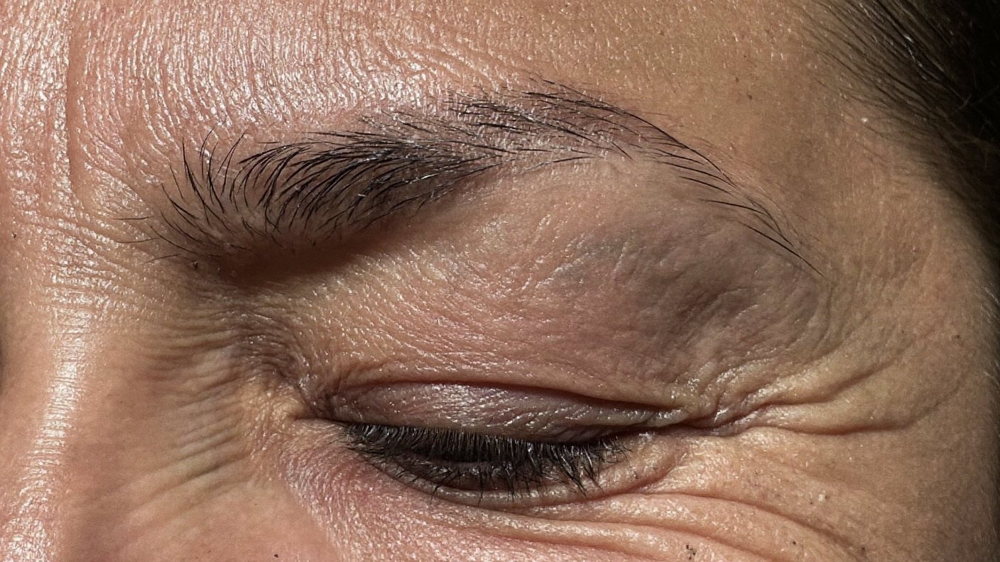 Close-up of an eyebrow with the outer end missing