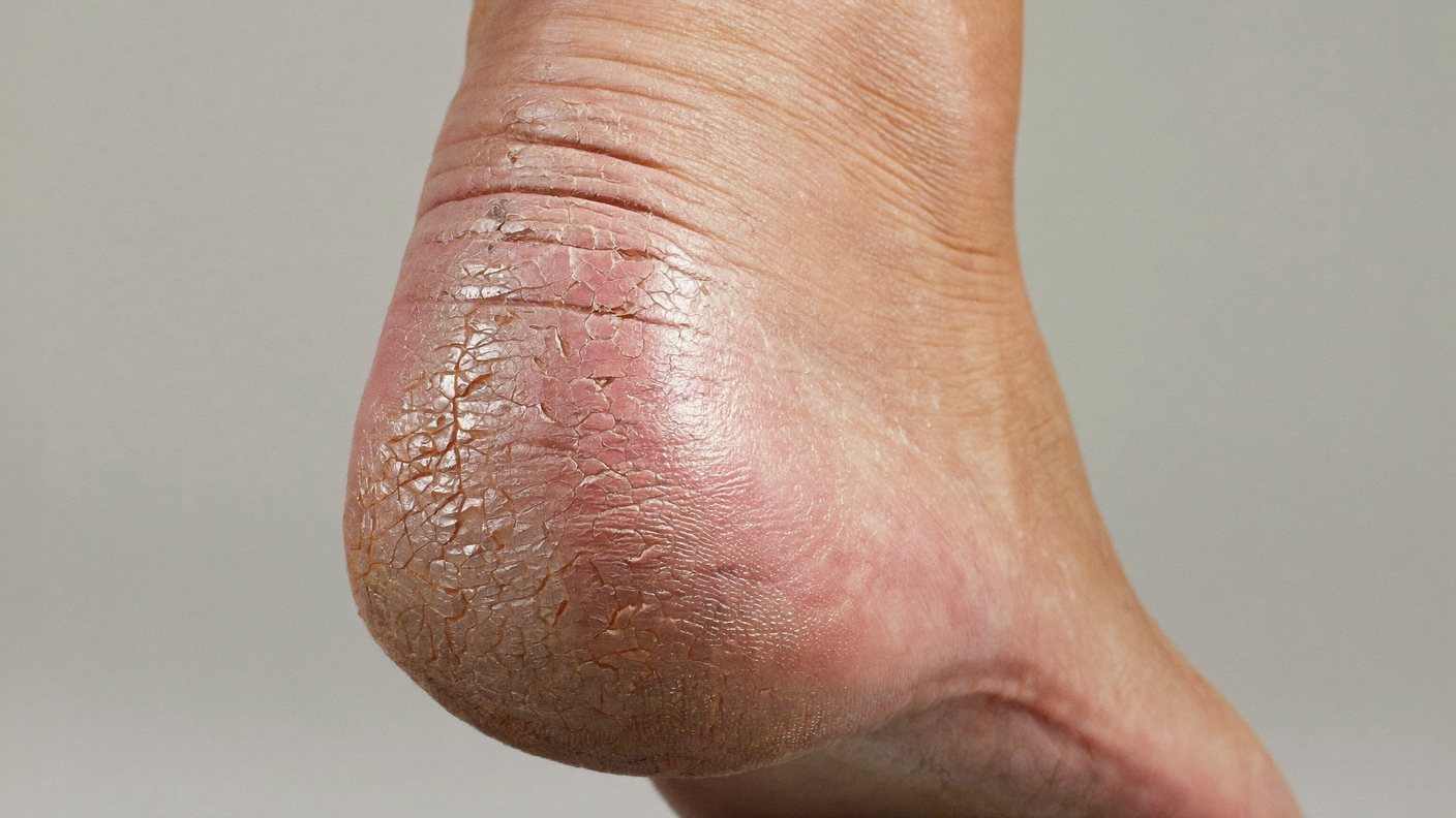 Close-up of a deeply cracked dry heel