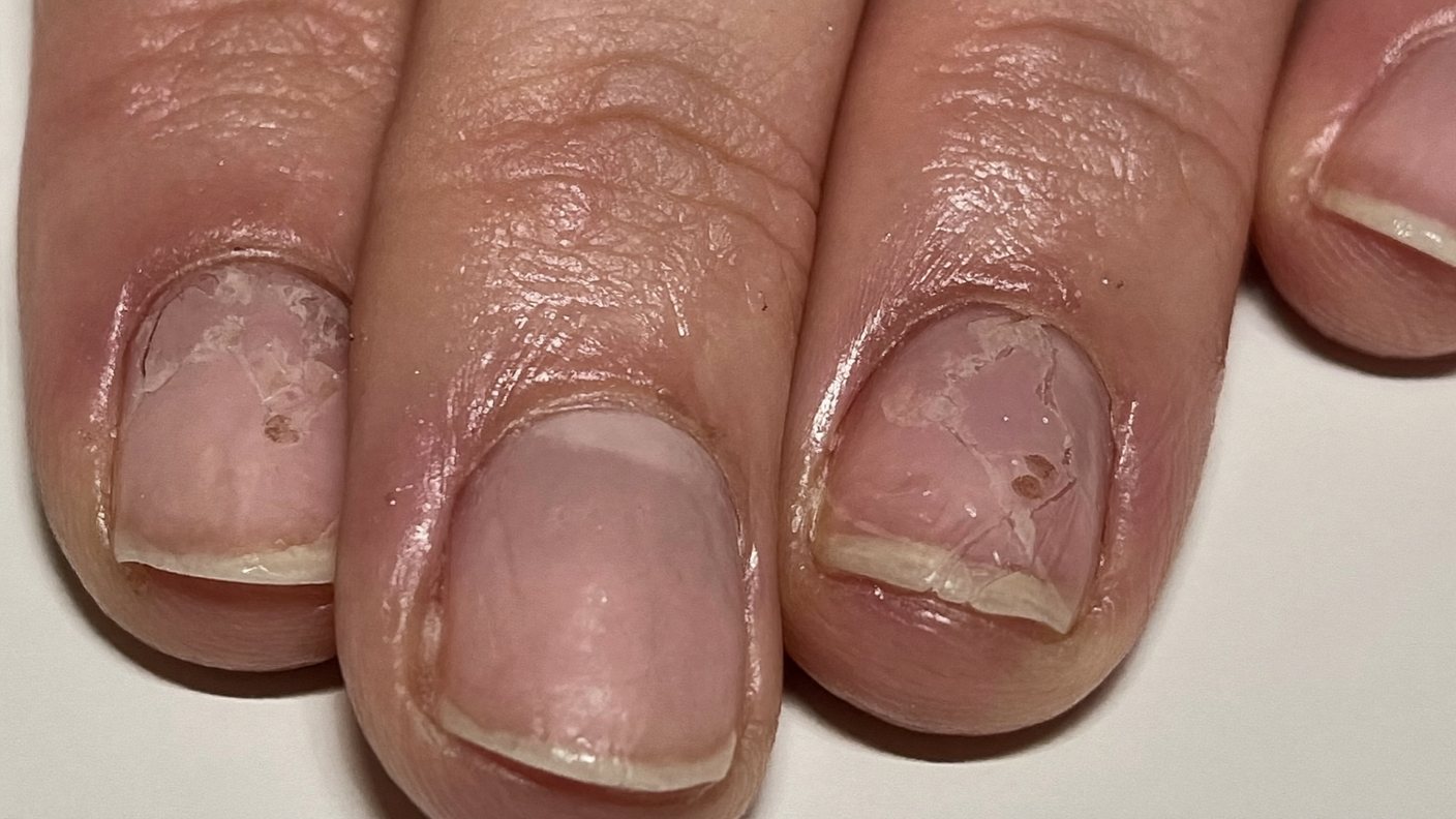 Close-up of split peeling fingernails